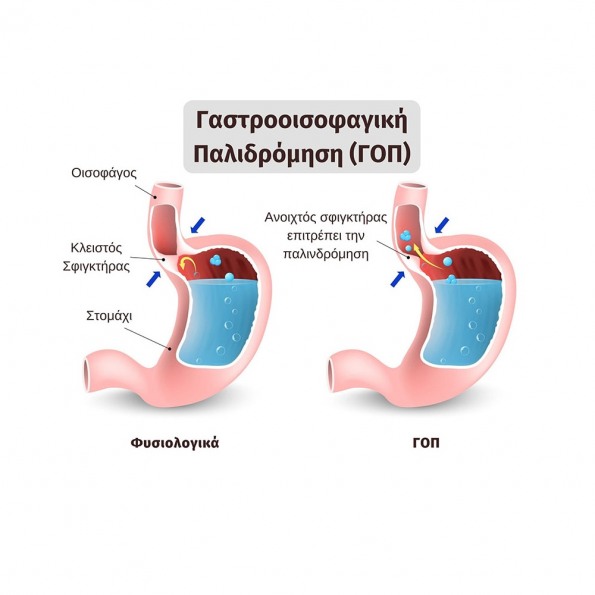 ΓΑΣΤΡΟΟΙΣΟΦΑΓΙΚΗ ΠΑΛΙΝΔΡΟΜΗΣΗ ΚΑΙ ΓΟΠ: ΚΑΤΑΛΛΗΛΟ ΓΙΑ 0-2 ΕΤΩΝ